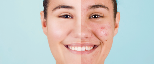 Acne: Causes & Natural Remedies